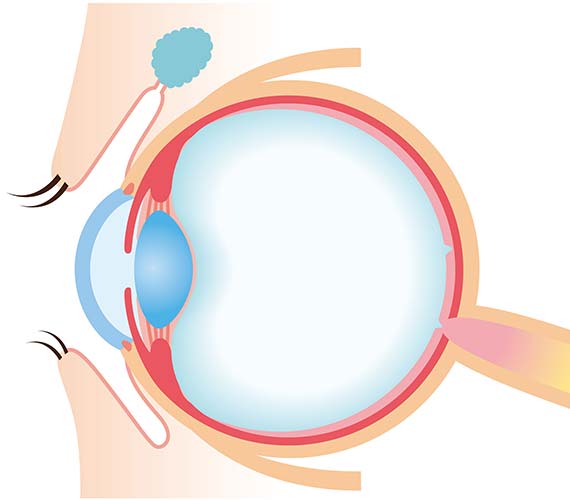 網膜硝子体疾患
